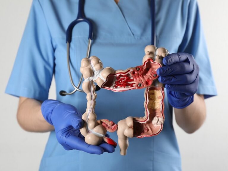 cancerdeintestino